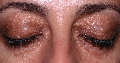 Remove Syringomas Permanently At Home With These Amazing 6 Natural