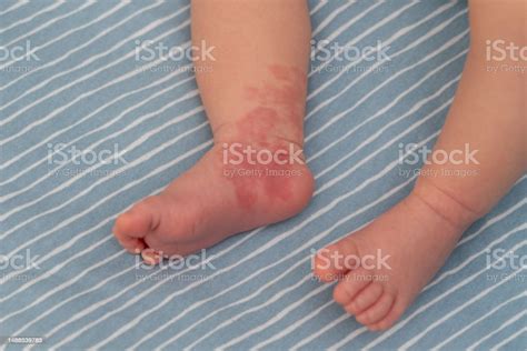 Hemangioma Red Birthmark On Leg Of Newborn Baby Stock Photo Download