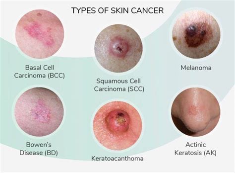 It will help you feel better i think if someone actually examines your nails rather than speaking to a doctor on the phone. Symptoms of Skin Cancer, Risk Factors, Signs & Causes - My ...