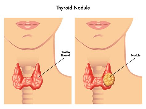 Thyroid Nodules Biopsy