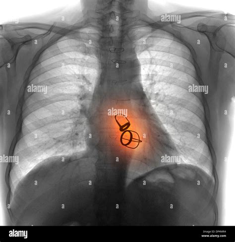 Prosthetic Heart Valves X Ray Stock Photo Alamy