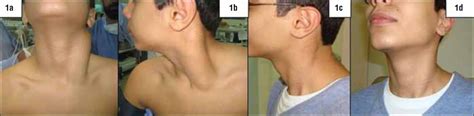 Diffuse Idiopathic Hyperplasia Of The Sternocleidomastoid Muscle In A