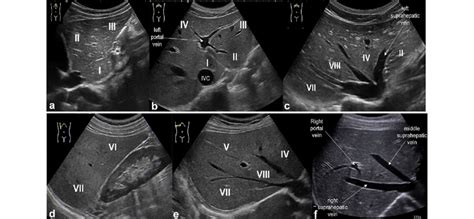 Us Study Of The Liver Longitudinal And Transverse Scan Along The