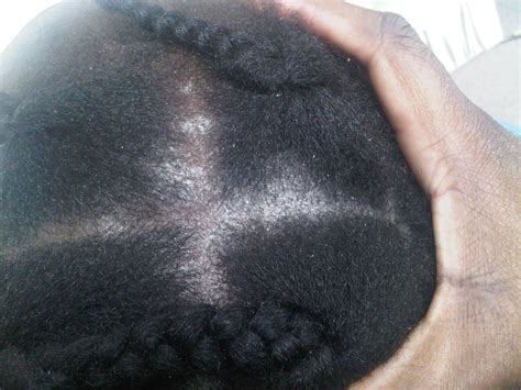 Scalp Fungus Pictures Pictures Photos