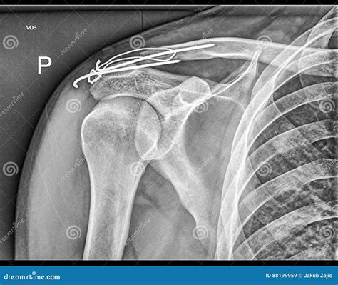Broken Clavicle Bone Fixation Fracture Repair Stock Image Image Of