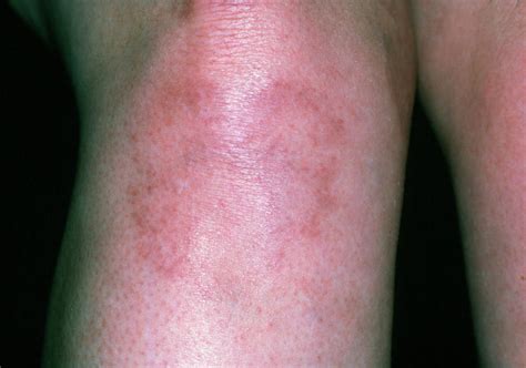 Systemic Lupus Erythematosus Rash On Womans Leg Photograph By Dr P Marazziscience Photo Library