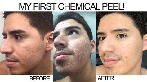 Acne Scars Before And After Chemical Peel