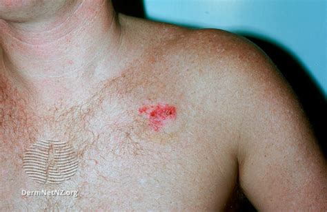 Filesuperficial Basal Cell Carcinoma Chest Dermnet Nz Superficial