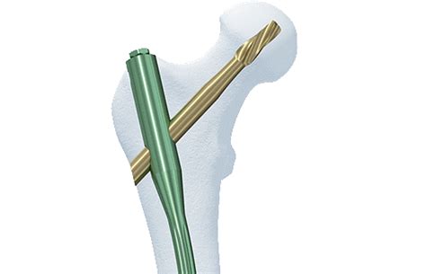 Titanium Trochanteric Fixation Nail System Proximal Femur Fractures