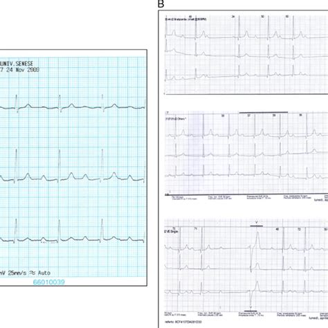 Electrocardiograms Ecgs Of Case 2 A Resting Ecg Showed Fi
