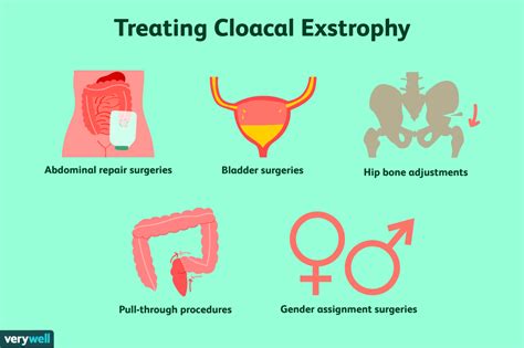 Cloacal Exstrophy Symptoms Causes And Treatment