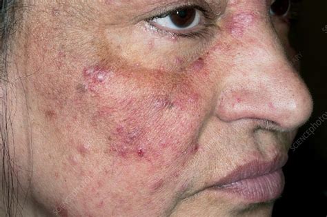 Acne Rosacea On The Face Stock Image C0119530 Science Photo Library