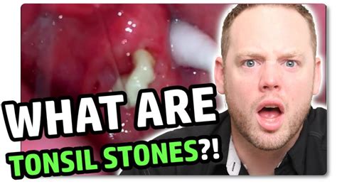 Tonsil Stones Explained In Under 3 Minutes Youtube