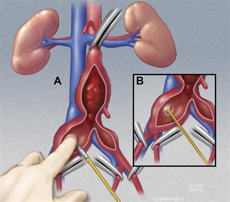 Common Iliac Artery Aneurysm Expansion Rate And Results Of Open