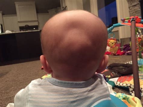 Flat Spotindent On Back Of Head Babycenter