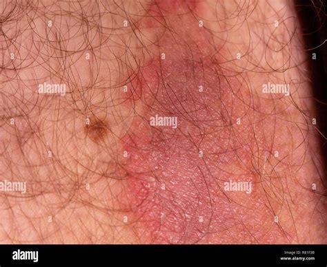 Rash Leg High Resolution Stock Photography And Images Alamy