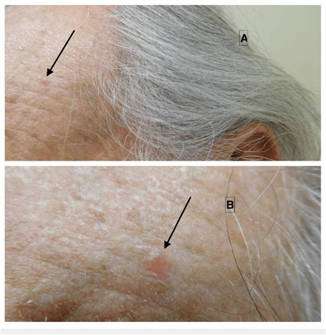 Clinical Features Of Basal Cell Carcinoma With Myoepithelial