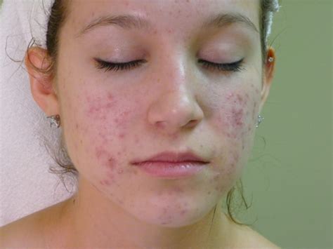 Face Mapping Acne Spots And What Every Acne Spot Means