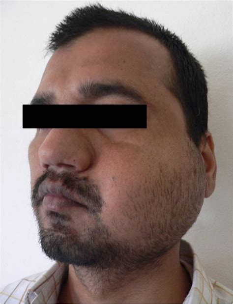 Swelling On The Left Side Of The Face