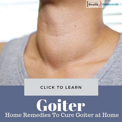 Home Remedies To Cure Goiter At Home Its Causes And Symptoms Essential
