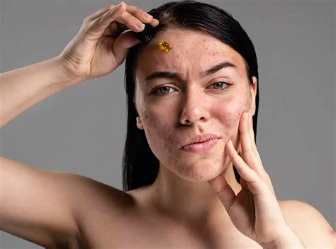 10 Best Essential Oils For Acne And How To Use