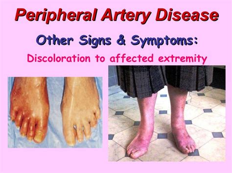 Peripheral Artery Disease Bmhtele