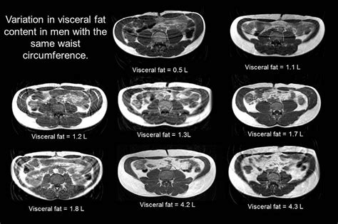 Difference Between Visceral Fat And Subcutaneous Fat Compare The