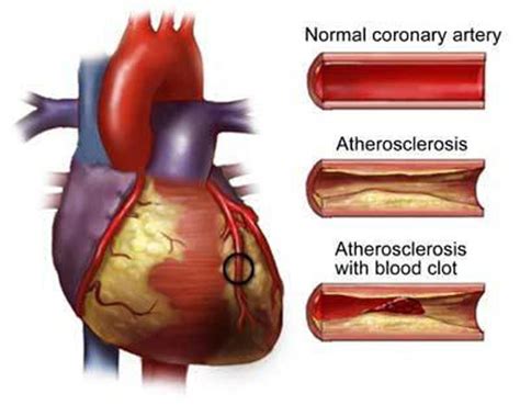 The age adjusted death rate is 157.39 per 100,000 of population ranks malaysia #64 in the world. Hypertensive Heart Disease Symptoms And Prevention