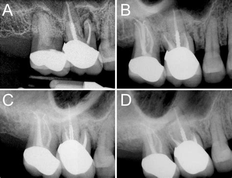 Healing Of Apical Periodontitis In A Maxillary Second Molar With Fused
