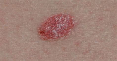 Psoriasis Or Skin Cancer How To Tell The Difference