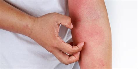 La Dermatitis Alérgica De Contacto Produce Picazón Y Enrojecimiento De