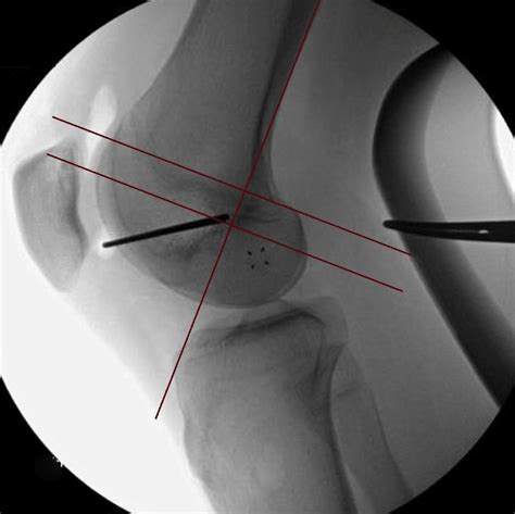 Anatomic Medial Patellofemoral Ligament Reconstruction Without Bone