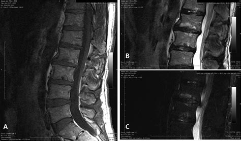 Discovertebral Erosions In Patients With Enteropathic Spondyloarthritis