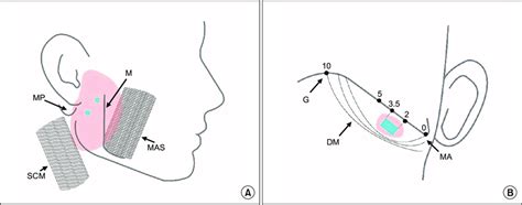 Locations Of The Non Ultrasound Guided Parotid Gland Injections A And
