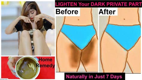 Lighten Your Dark Private Part Naturally In Just Days Rinkal Soni