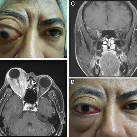 A Case 1 Severe Exophthalmos Congestion And Limited Eye Movement Of