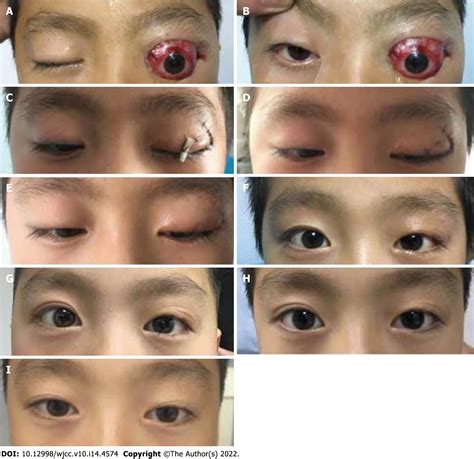 Globe Luxation May Prevent Myopia In A Child A Case Report