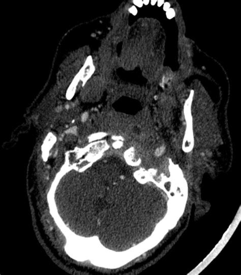 Malignant Otitis Externa Radiology