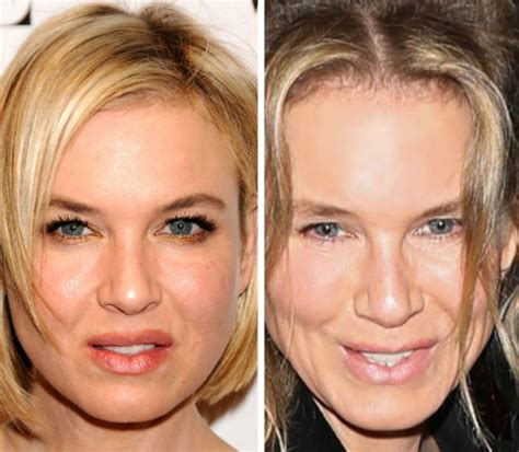 Renee Zellweger Plastic Surgery Before And After Botox Injections Celebie