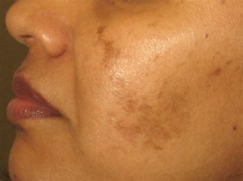 The victim,s skin turned black in patches and inflamed glands combined with compulsive vomiting, swollen tongue and splitting headaches. Skin Hyperpigmentation Pictures | Best Hyperpigmentation ...