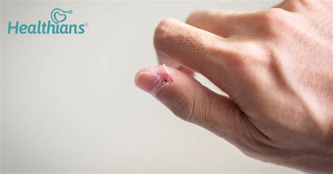 Is The Skin Around Your Nails Peeling Precautions And Natural Remedies
