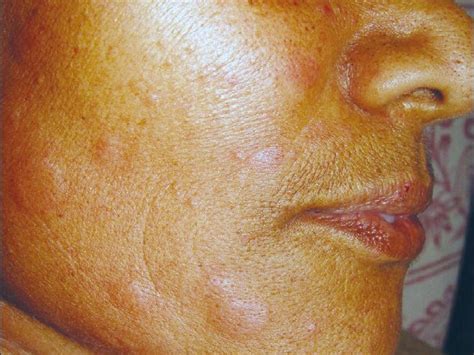 Hives On Face Treatments Symptoms Causes And Outlook Medical News