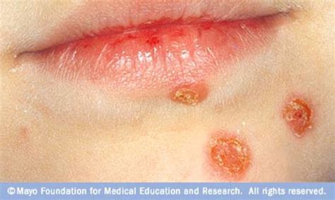 What Is Mrsa And Impetigo Signs And Symptoms Treatment Diagnosis And