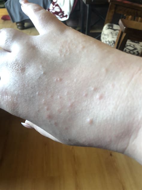 Weird Bumps On One Hand Arm Not Really Itchy Appeared Out Of Nowhere