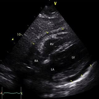 Transthoracic Echocardiogram Two Dimensional Subcostal View Of The