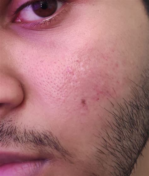 Bumpy Skin Texture And Apparent Hypertrophic Scars