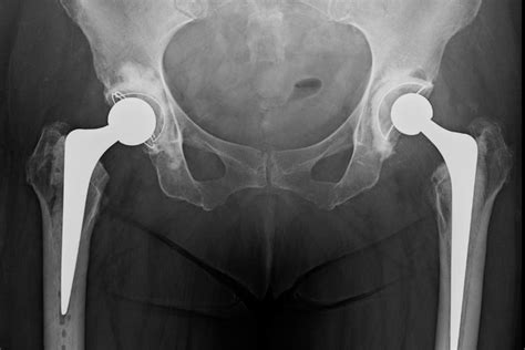 Hip Revision Surgery Ross Crawford
