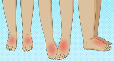 11 Alarming Medical Conditions That Can Make Feet Puff Up Swelling