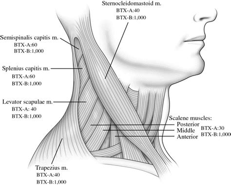 Treatment Of Cervical Dystonia With Botulinum Toxin Operative