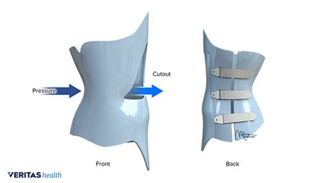 Types Of Scoliosis Braces